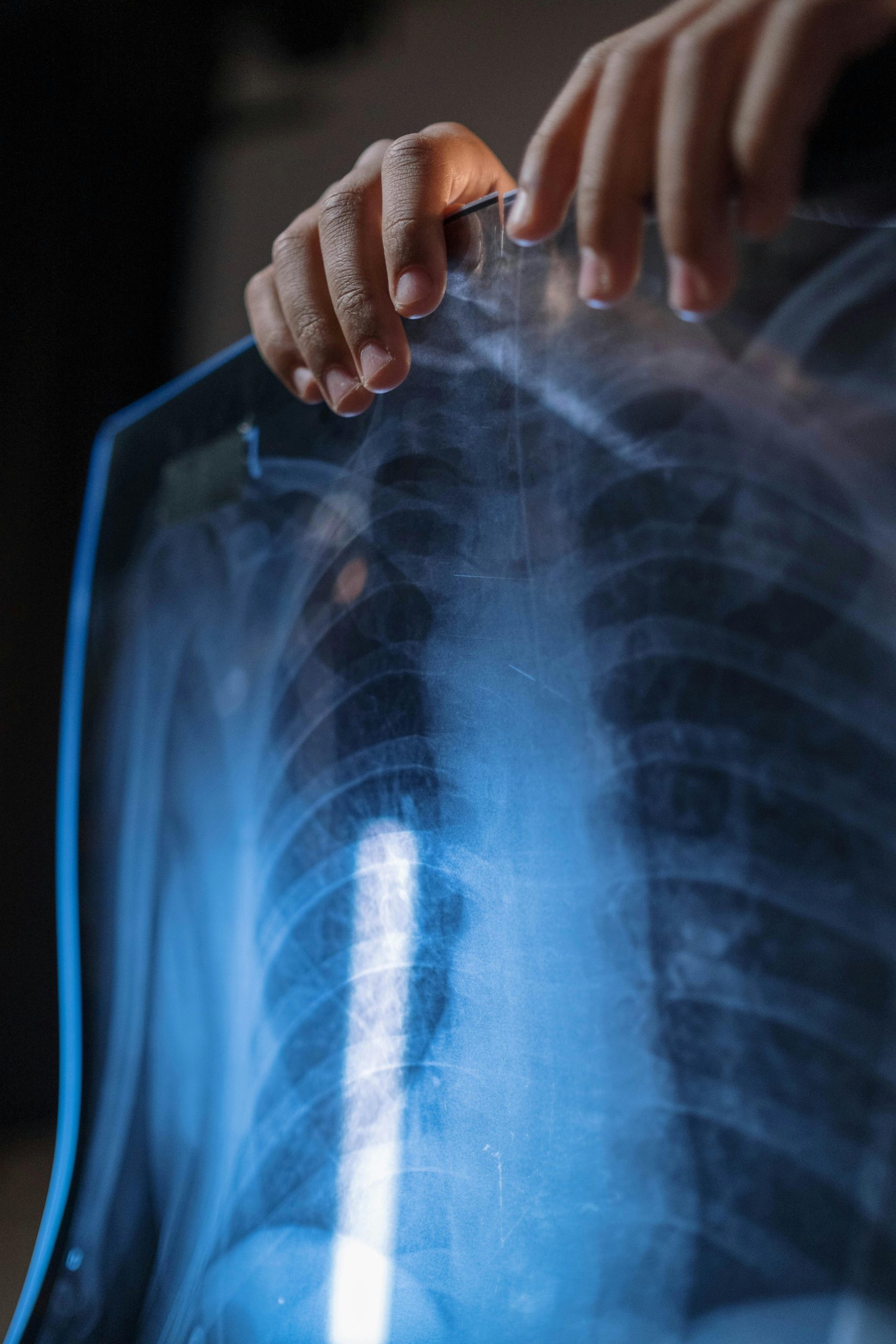 Accentuation de la trame bronchique : causes et solutions essentielles