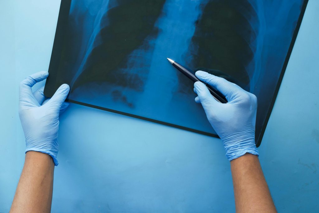 Un médecin en gants bleus examine une radiographie pulmonaire avec un stylo, se concentrant sur le diagnostic médical.