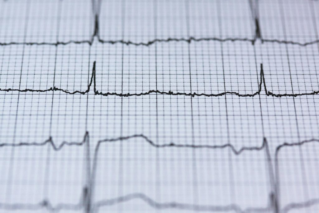 Close-up d'une lecture d'ECG sur papier millimétré, affichant le rythme cardiaque et les données de pouls pour une analyse médicale.